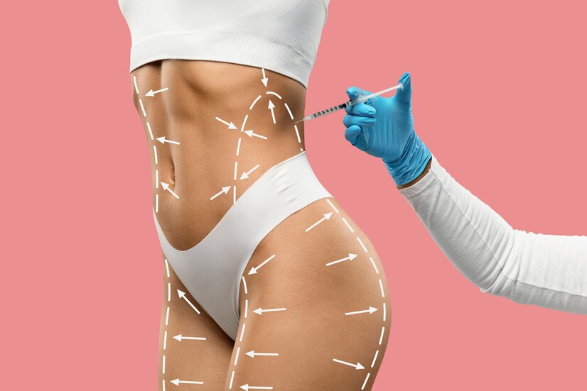 Get Smooth, Sculpted Curves Instantly With Laser Liposuction by pookie46