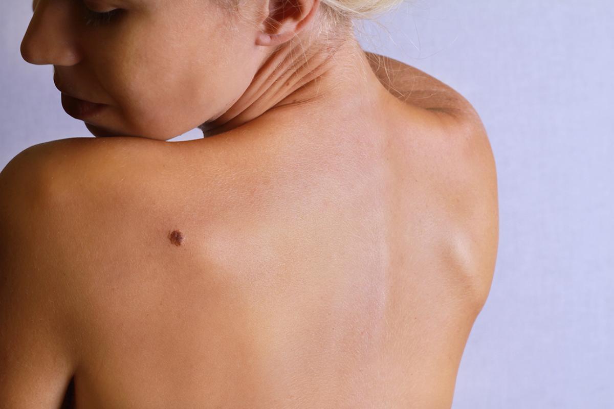 Does The Best Birthmark Removal Require A Specialist? Does The Best Birthmark Removal Require A Specialist? by MuhammadAhmad