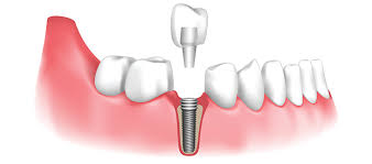 How Much Dental Implants Cost by zaid
