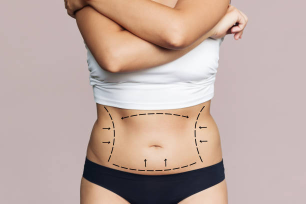 How Long Do Liposuction Results Really Last? by Enfieldabudhabi