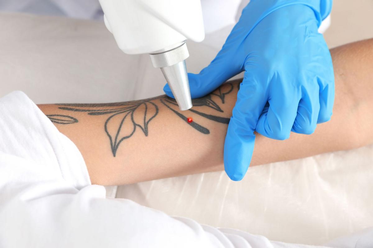 How Does Laser Tattoo Removal Actually Work On Skin? by Dynamic Life Clinic