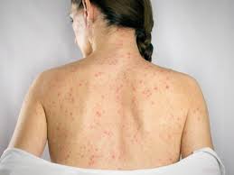 What Sudden Shingles Symptoms Could Mean For Your Overall Health by enfieldroyalsaudi050