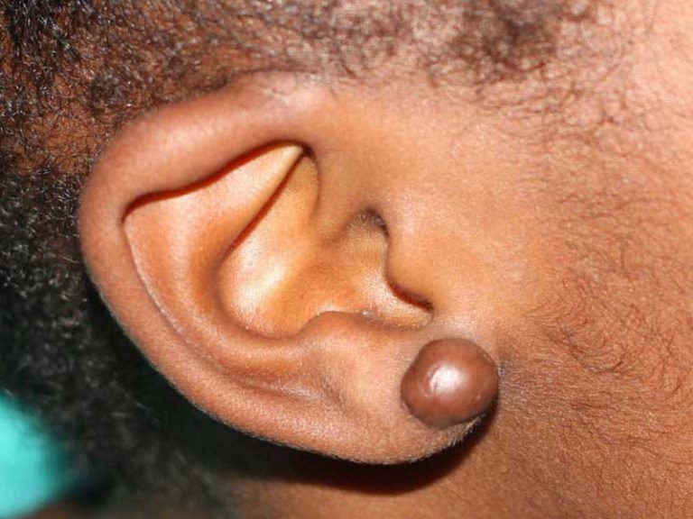 Are Keloid Treatments Safe And Suitable For People With Darker Skin? by dynamicaesthetic