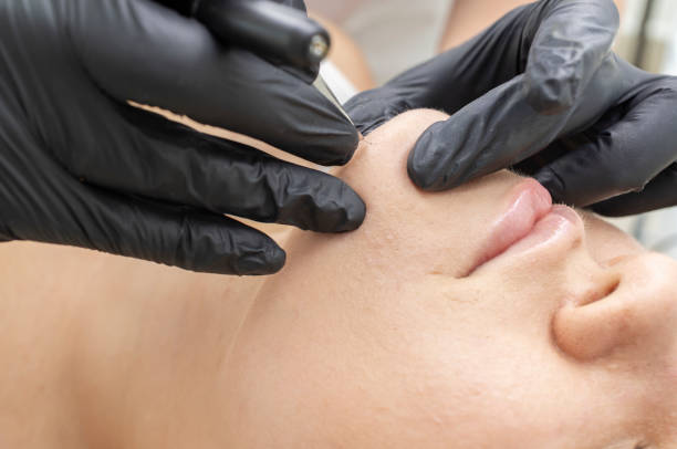 Can Electrolysis Remove Chin And Upper Lip Hair? by Enfieldabudhabi