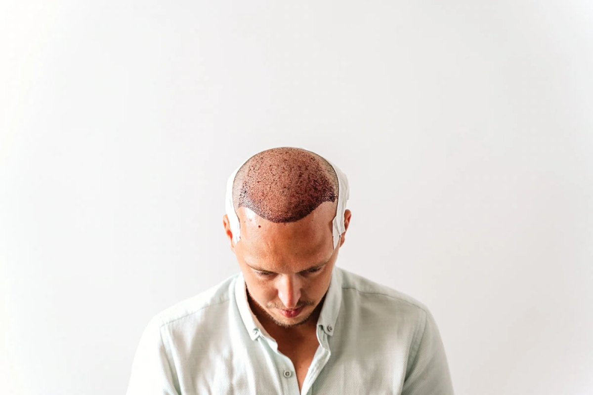 Can A Male Hair Transplant Stop Future Hair Loss? by fatimadynamic