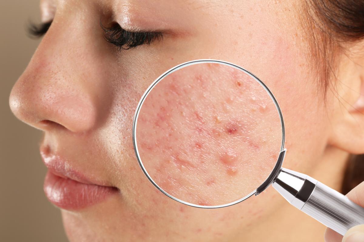 What Is The Latest In Acne Scar Treatment? What Is The Latest In Acne Scar Treatment? by MuhammadAhmad