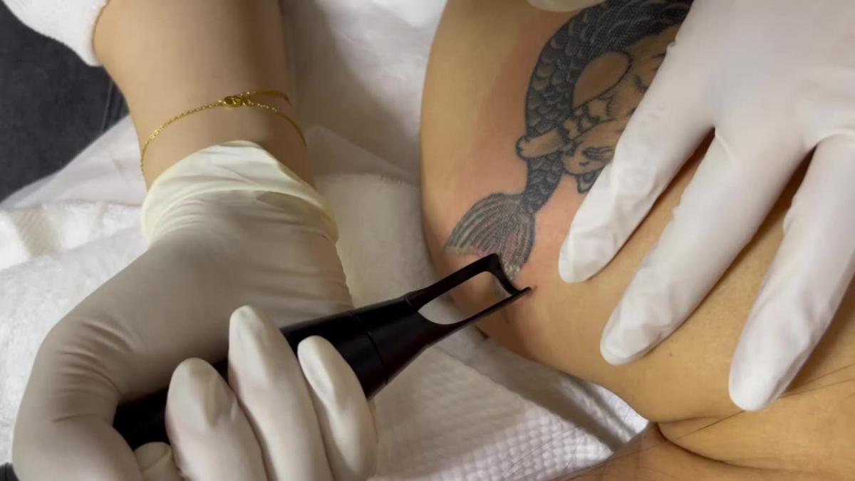 Is PicoSure Tattoo Removal Better Than Laser? Is PicoSure Tattoo Removal Better Than Laser? by MuhammadAhmad