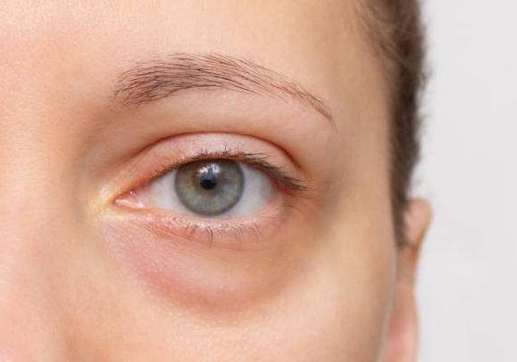 Does Aging Impact Dark Circles Treatment Success? Does Aging Impact Dark Circles Treatment Success? by MuhammadAhmad