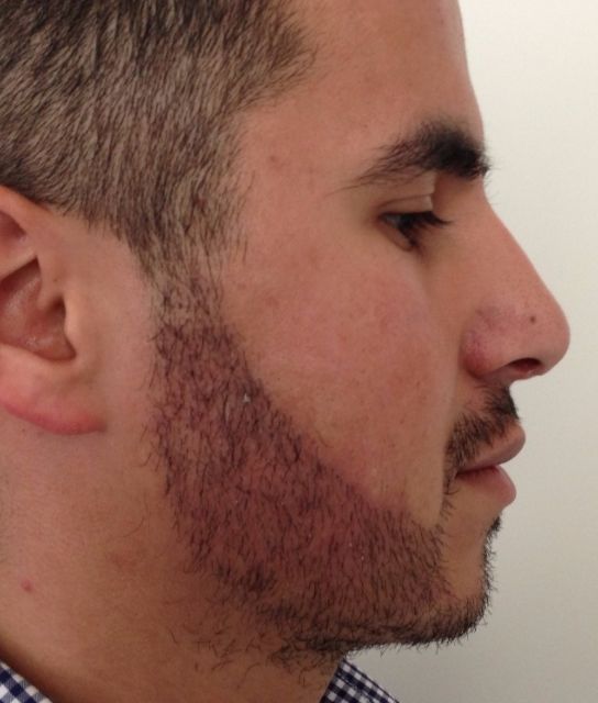 Pros And Cons Of Beard Hair Transplant: Is It The Right Choice For You? by Royal Clinic Saudia