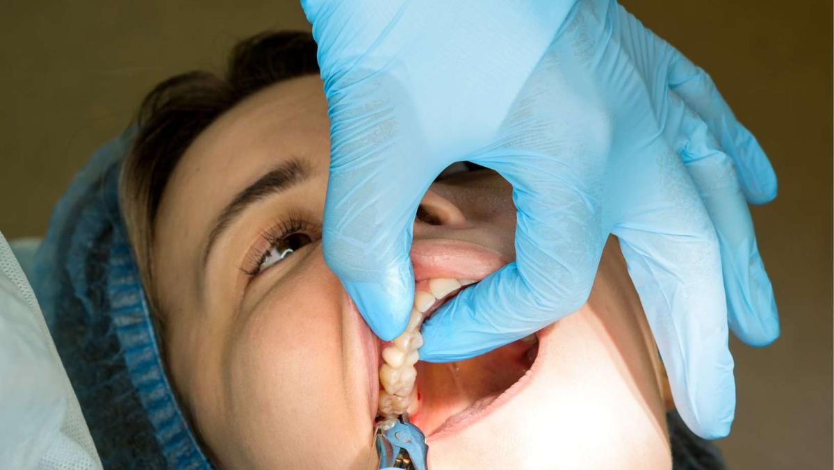 How To Reduce Anxiety Before Surgical Tooth Removal? by Aesthethic Clinic
