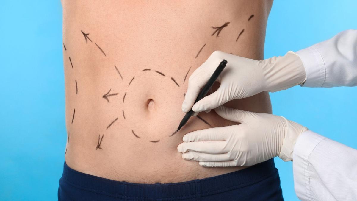 How Does GPS Laser Liposuction Work? by Dynamicclinic12